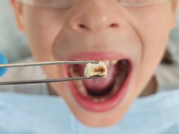 Best Tooth Infection Emergency Dentist  in Timberne, LA